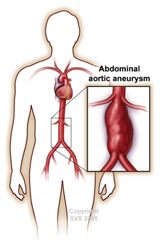artery aneurysms treatments surgery stents