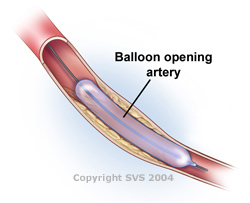 artery angioplasty poor circulation legs