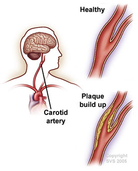 carotid artery plaque surgery