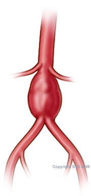 aneurysm repair stent graft