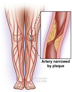 peripheral artery disease PAD legs