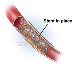 stent leg artery for poor circulation