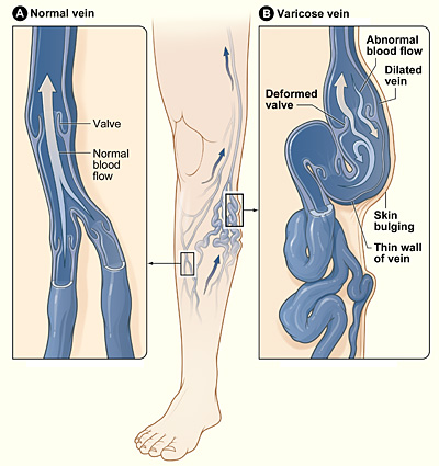 treatment varicose veins legs