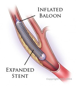 carotid artery stent