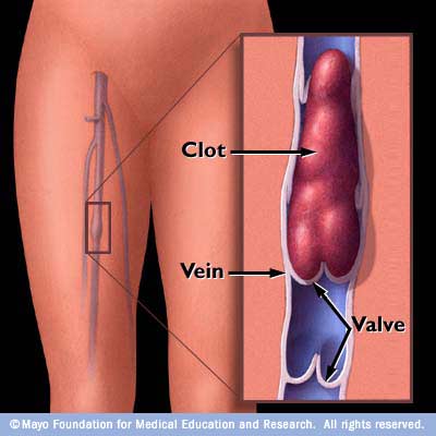 blood clots phlebitis legs