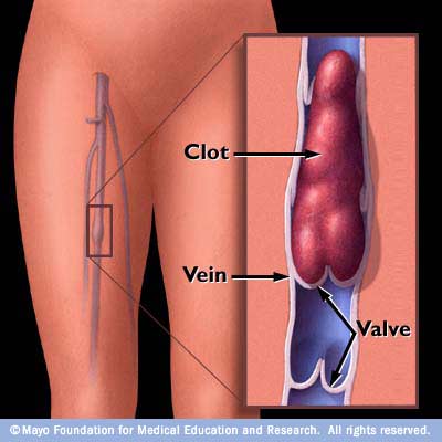 Deep vein thrombosis penis