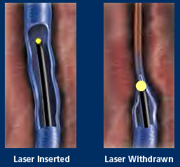 Endovenous Laser Varicose Vein Treatment
