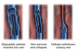 Radiofrequency Varicose Vein Ablation Treatment