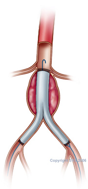 aneurysm repair stent surgery