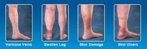 Leg Vein Services Austin