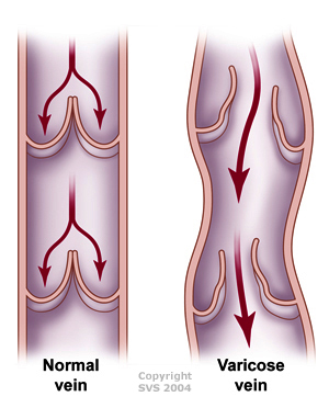 varicose vein valve reflux disease