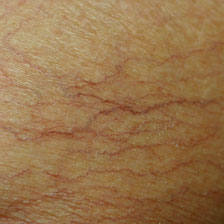 spider veins skin