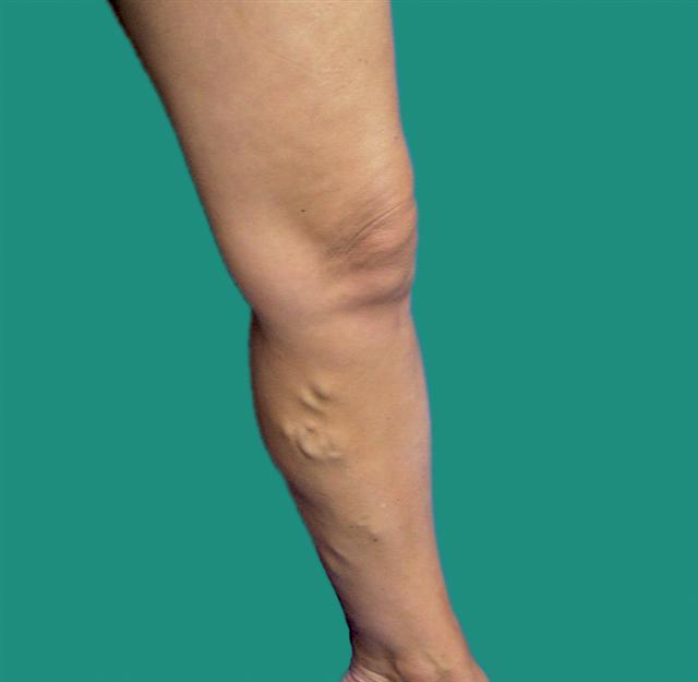 What is Venous Insufficiency? - VeinSolutions Austin