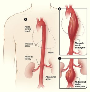 Artery Aneurysm Aortic Aneurysm Repair AAA Austin Texas