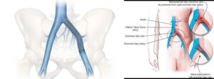 May Thurner Syndrome Stent Austin Texas