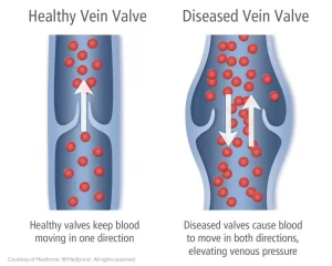 pelvic venous congestion pelvic varicose veins